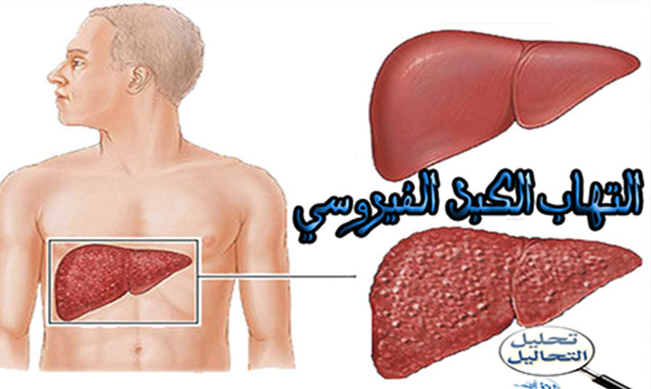 التهاب الكبد