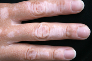 Vitiligo