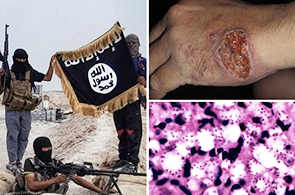 Jihadistes atteints de leichmaniose